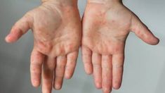 Recomiendan la consulta temprana especialmente en niños. Recomiendan la consulta temprana especialmente en niños.