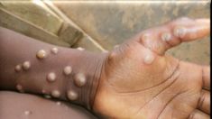 El virus se presenta con síntomas de fiebre, dolor de cabeza, dolores musculares, dolor de espalda, ganglios linfáticos inflamados, escalofríos y fatiga. El virus se presenta con síntomas de fiebre, dolor de cabeza, dolores musculares, dolor de espalda, ganglios linfáticos inflamados, escalofríos y fatiga.