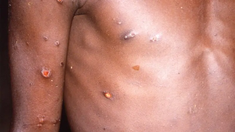 Las personas que padecen mpox deben aislarse hasta que todas sus lesiones hayan desaparecido. Las personas que padecen mpox deben aislarse hasta que todas sus lesiones hayan desaparecido.