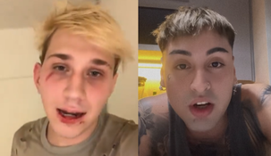 En un video Brunenger mostró sus heridas y denunció que Tiago Pzk y sus amigos lo golpearon en un boliche.&nbsp;
