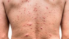 Ya hay cinco casos de viruela del mono en Argentina. Ya hay cinco casos de viruela del mono en Argentina.