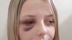 Así quedó el rostro de la joven luego de la fuerte agresión recibida Así quedó el rostro de la joven luego de la fuerte agresión recibida