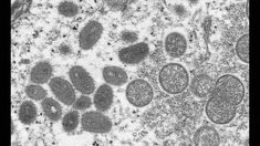 En 2022, una epidemia mundial, causada por el subtipo clade 2, se propagó en un centenar de países. En 2022, una epidemia mundial, causada por el subtipo clade 2, se propagó en un centenar de países.