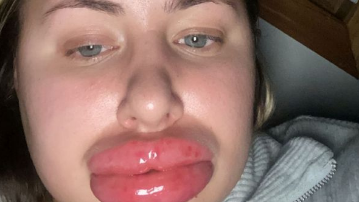 Joven se rellenó los labios, sufrió una reacción alérgica y sus amigas la  comparan con un personaje de Monsters Inc