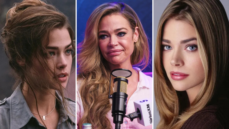 El procedimiento combinó lifting facial, blefaroplastia y técnicas de relleno para redefinir el rostro y mejorar su textura general. El procedimiento combinó lifting facial, blefaroplastia y técnicas de relleno para redefinir el rostro y mejorar su textura general.