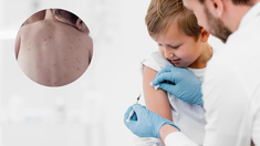 La vacuna contra el sarampión es la triple viral, incluida en el calendario. La vacuna contra el sarampión es la triple viral, incluida en el calendario.