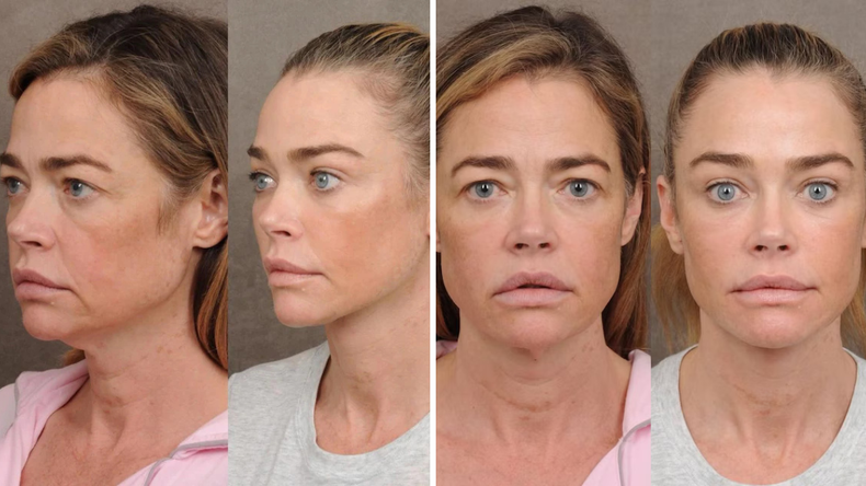 La intervención estética coincidió con un proceso personal complejo, lo que amplificó la atención mediática sobre la actriz. La intervención estética coincidió con un proceso personal complejo, lo que amplificó la atención mediática sobre la actriz.