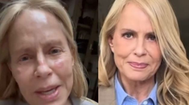 La chilena mostró las lesiones que quedaron en su cara después del tratamiento facial.