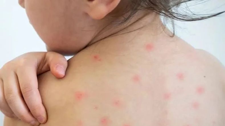 Measles. 