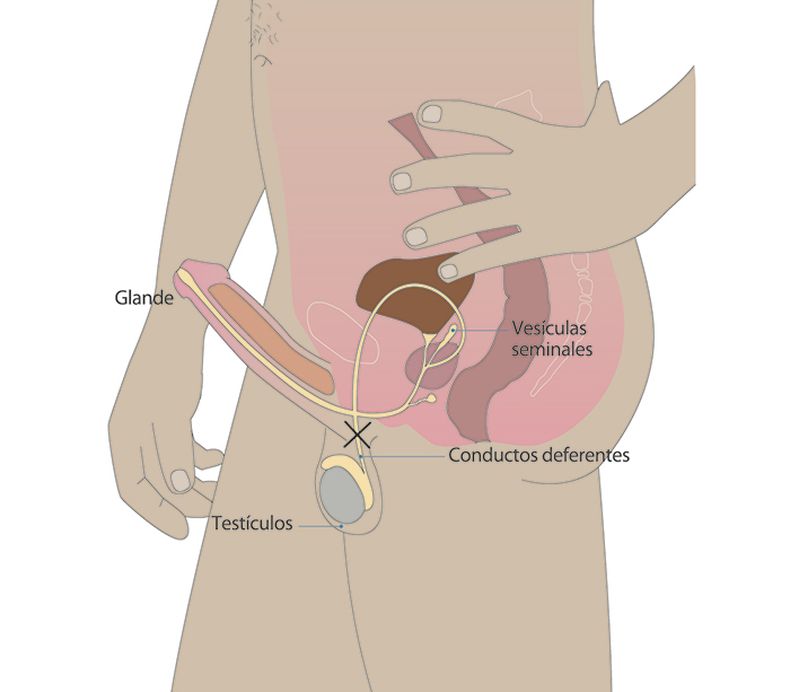 La vasectomía impide el paso de los espermatozoides al resto del semen.
