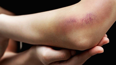 Entre los signos de este tipo de cáncer está la pérdida inexplicable de peso, inflamación de ganglios linfáticos, sangrado fácil y formación de hematomas. Entre los signos de este tipo de cáncer está la pérdida inexplicable de peso, inflamación de ganglios linfáticos, sangrado fácil y formación de hematomas.