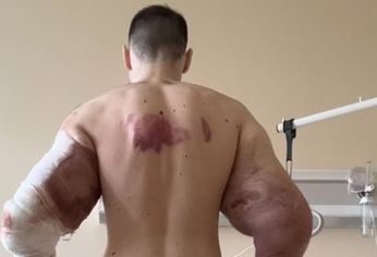El Popeye Ruso podría perder sus brazos por la inyección de aceite