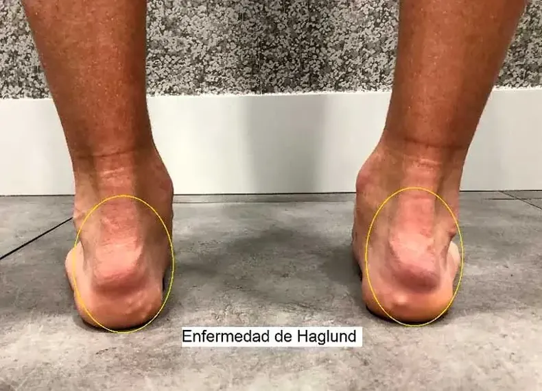 Así se ve esta malformación.