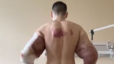 El Popeye Ruso podría perder sus brazos por la inyección de aceite El Popeye Ruso podría perder sus brazos por la inyección de aceite