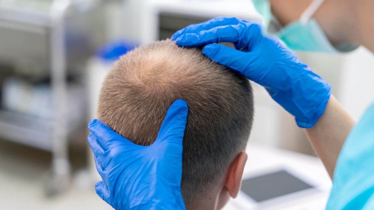 Alerta Hombres: Estudio Reveló Qué Bebidas Aceleran La Caída De Cabello