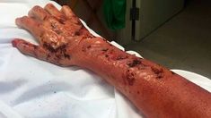¡Qué impresión! ¿A qué famosa pertenece esta mano quemada? ¡Qué impresión! ¿A qué famosa pertenece esta mano quemada?