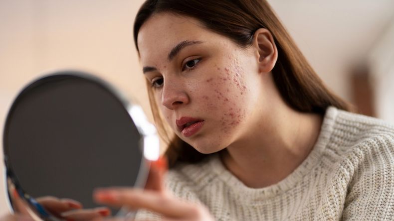 Visitar al dermatólogo es clave para tratar los granos y el acné facial.