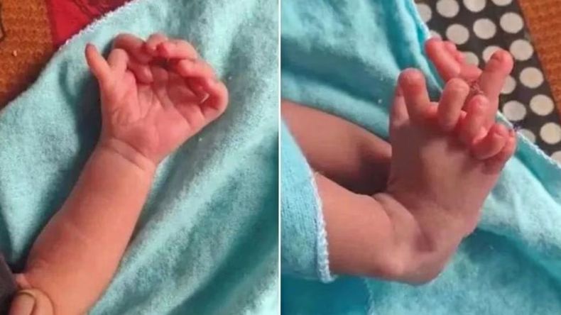 India: nació una niña con 26 dedos y creen que es la reencarnación de una diosa.
