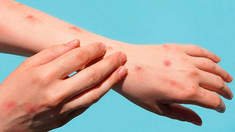 La viruela símica se transmite de persona a persona por contacto directo. La viruela símica se transmite de persona a persona por contacto directo.