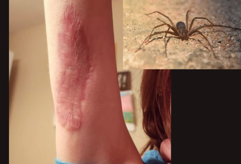 El diagnóstico que recibió la niña se vincula a la picadura de un animal particular El diagnóstico que recibió la niña se vincula a la picadura de un animal particular