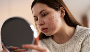 Visitar al dermatólogo es clave para tratar los granos y el acné facial.