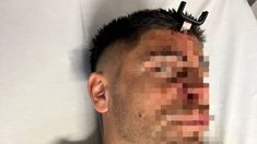 La víctima del intento de homicidio con una llave de vehículo. La víctima del intento de homicidio con una llave de vehículo.