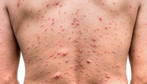 Trece casos confirmados de viruela del mono en el país.