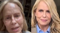 La chilena mostró las lesiones que quedaron en su cara después del tratamiento facial. La chilena mostró las lesiones que quedaron en su cara después del tratamiento facial.