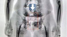 La radiografía que delató a la mujer que llevaba droga escondida en el ano. La radiografía que delató a la mujer que llevaba droga escondida en el ano.