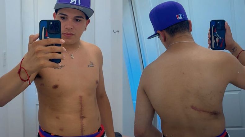 Thiago Medina mostró sus cicatrices en Instagram.