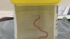 Sacaron una lombriz de ocho centímetros del cerebro de una mujer. Sacaron una lombriz de ocho centímetros del cerebro de una mujer.