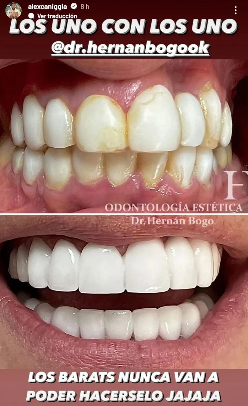 Los cambios en la dentadura de Alex Caniggia.