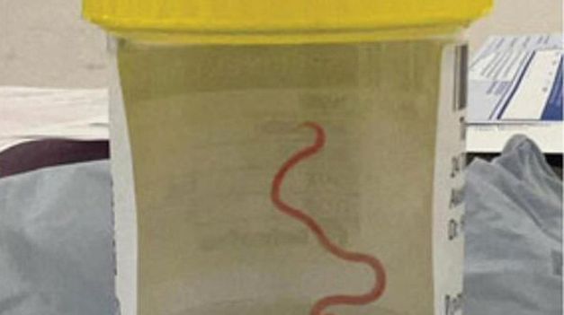 Sacaron una lombriz de ocho centímetros del cerebro de una mujer.