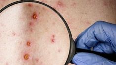 Santiago Molino comenzó a notar los primeros síntomas hace más de un mes. Santiago Molino comenzó a notar los primeros síntomas hace más de un mes.