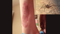 El diagnóstico que recibió la niña se vincula a la picadura de un animal particular El diagnóstico que recibió la niña se vincula a la picadura de un animal particular